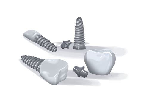 Dental Implant Failure Rate Symptoms And Causes Authority Dental