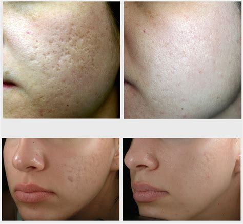 Effective Acne Scar Treatment For Brides To Be Feel Good Laser And Skin