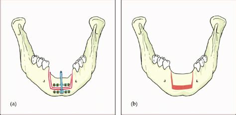 Alveolar Do For Atrophic Mandibular Anterior Ridge A Application Of