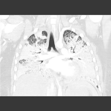 Diffuse Alveolar Hemorrhage Goodpasture Syndrome Image