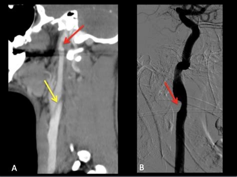 Carotid Dissection Sagittal Contrast Enhanced Ct Image A Shows