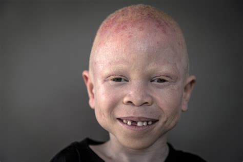 Albino Children In Tanzania Targeted By Body Part Hunters The Atlantic