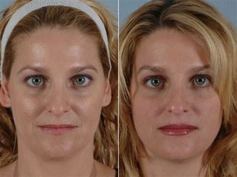 Facial Injectables In Philadelphia Pa W Cosmetic Surgery
