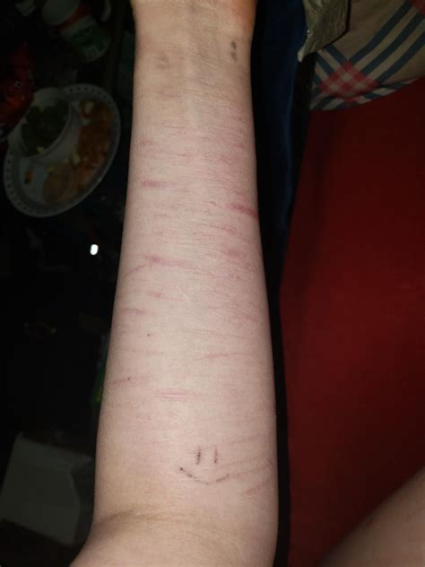 · ping an elastic band or hair band on your wrist (but not. Part of my self harm scars looked 1/10 what it used to ...