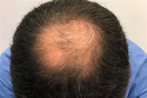 La Alopecia Androgénica En Hombres Características Y Soluciones Dr