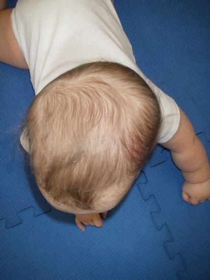 Positional Plagiocephaly A Condition Where The Back Or Side Of The