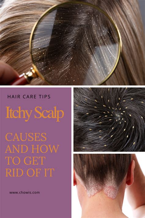 Itchy Scalp Causes And How To Get Rid Of It