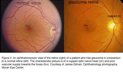What Is Glaucoma By David Krizaj Webvision