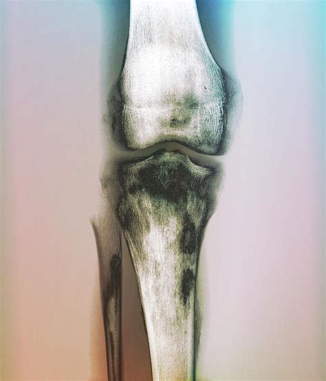 Bacterial Bone Infection Photograph By Zephyrscience Photo Library