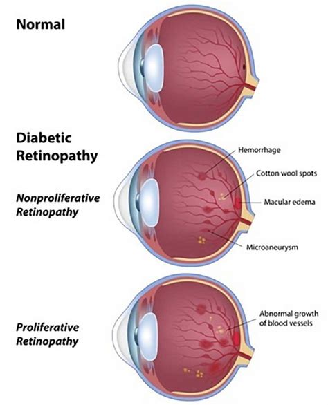 Diabetic Retinopathy Symptoms Causes Complications And Treatment