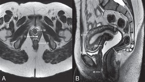 Normal Female Pelvis Axial A And Sagittal B MRI T Weighted Images Download Scientific