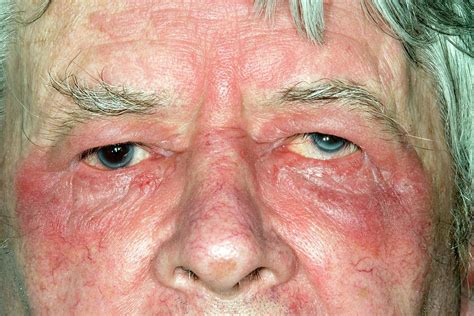 Eczema Around The Eye Photograph By Dr P Marazziscience Photo Library