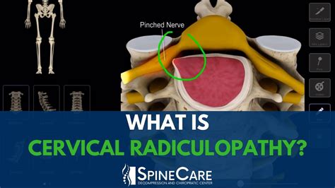 What Is Cervical Radiculopathy Youtube