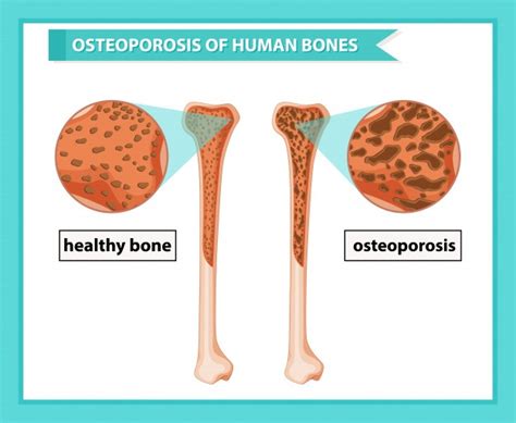 Osteoporosis Treatment Causes Symptoms And Treatment