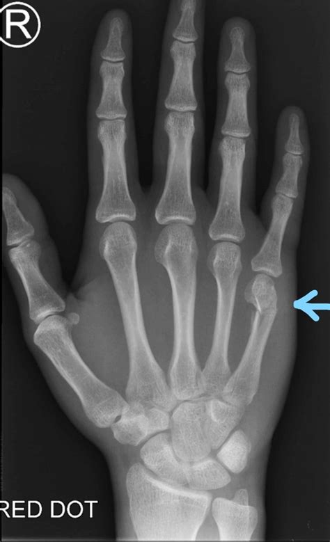 5th Metacarpal Fracture Surgery Captions Check
