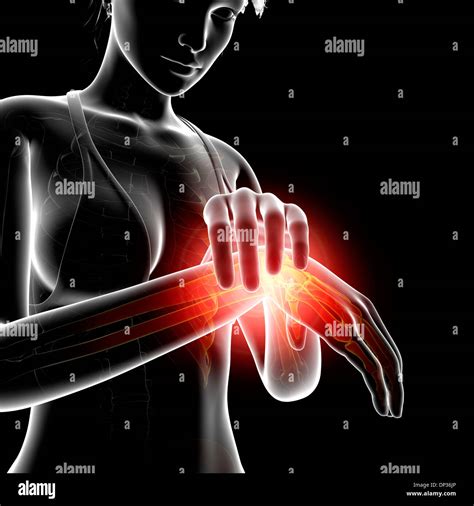 Wrist Pain Artwork Stock Photo Alamy