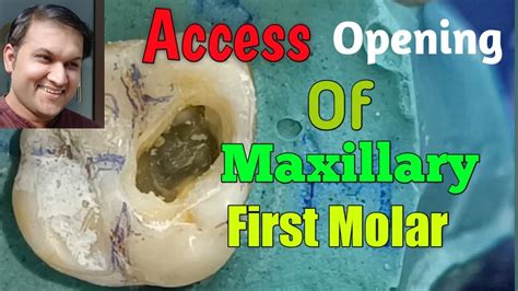 Access Opening Of Maxillary First Molar Most Simple Way To Locate