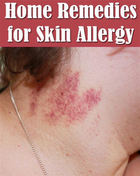 Home Remedies For Skin Allergy