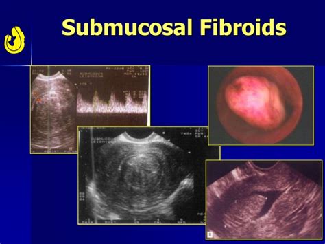 Uterine Fibroids Myomas And Infertility