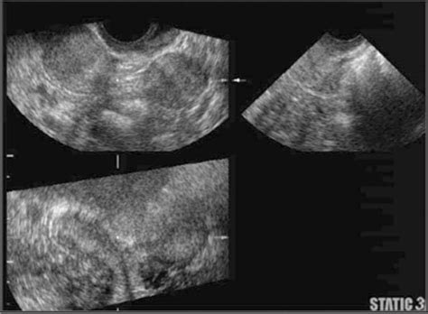 Didelphys Uterus Ultrasound