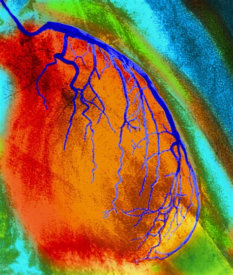 Coloured Angiogram Of Coronary Artery Of The Heart Photograph By Pixels