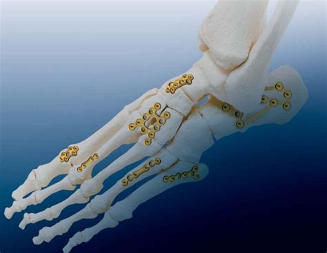 Foot Phalange Compression Plate Osteonic Tarsal Joint Calcaneus