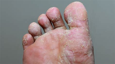 Fungal Infections Dermatology And Co Dermatology And Co
