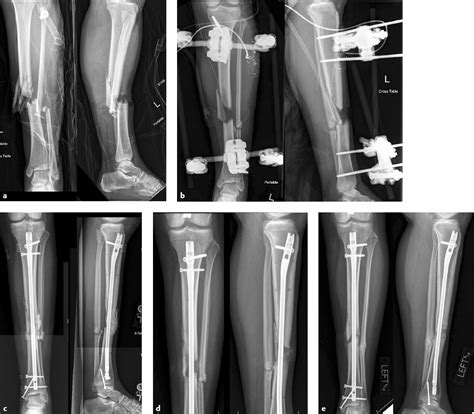 Treatment Strategy For Nonunion Musculoskeletal Key