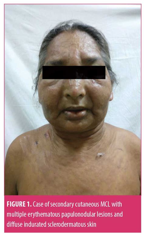 Secondary Cutaneous Mantle Cell Lymphoma Jcad The Journal Of