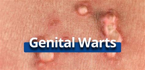 What Do Male Genital Warts Look Like