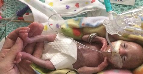 Earliest Premature Baby Ever Delivered Is Now A Toddler