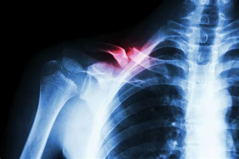 Q & A: What to Expect after Breaking a Collarbone | The Physical