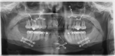 Truman Orthodontics Orthognathic Surgery