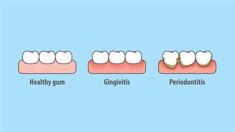 5 Warning Signs Of Gum Disease That You Should Look Out For Nutrition