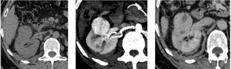 A B C Non Contrast Arterialand Nephrographic Phases Axial Ct