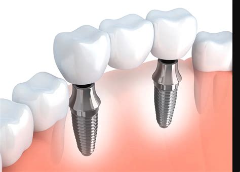 Dental Implants Platinum Dental Surgery