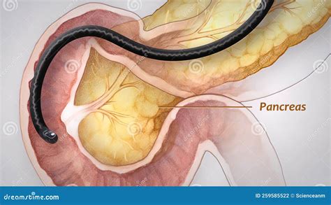 Pancreatic Endoscopy 3d Medical Illustration Stock Illustration