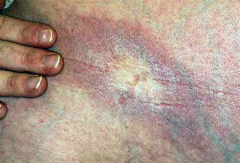 Picture Of Morphea Late Stage Rxlist