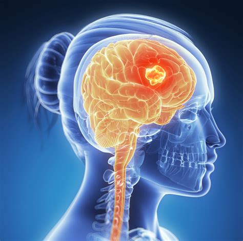Characteristics Of Brain Cancer You Must Know Pharmacy In City