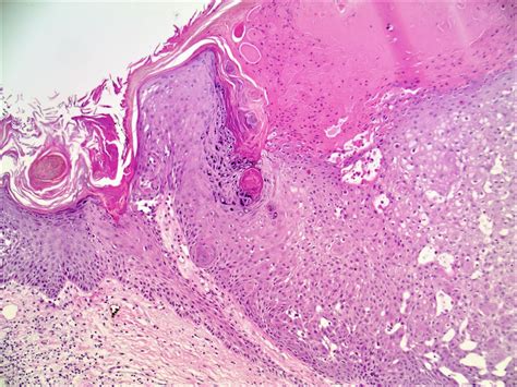 Pathology Outlines Inverted Follicular Keratosis