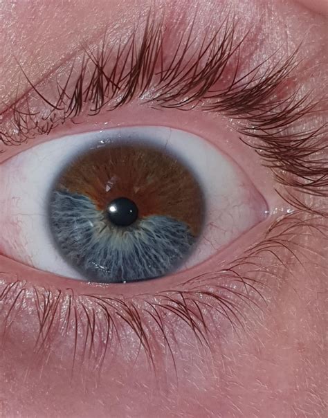 My Eye Has 2 Different Colors Rmildlyinteresting