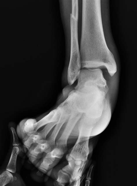 Stress X Ray Ankle