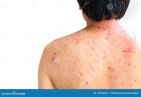 Men With Acne With Red Spots On The Back Stock Image Image Of