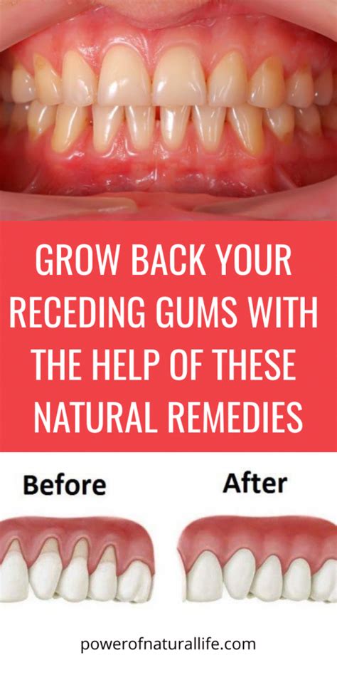 Grow Back Your Receding Gums With The Help Of These Natural Remedies