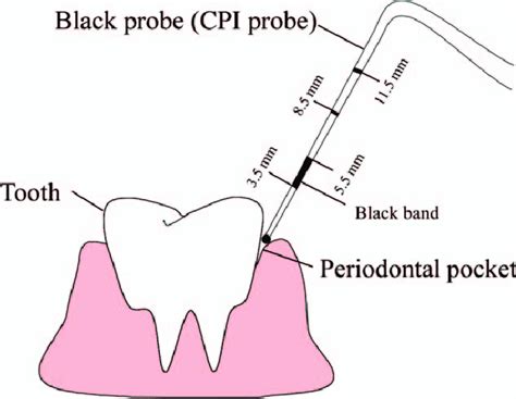 While the cpi probe provides spectacular imagery of the ice particles, its accuracy in measuring particle size. Dental CPI probe used for measuring periodontal pocket ...