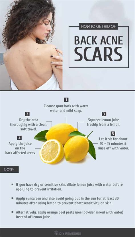 How To Get Rid Of Back Acne Scars