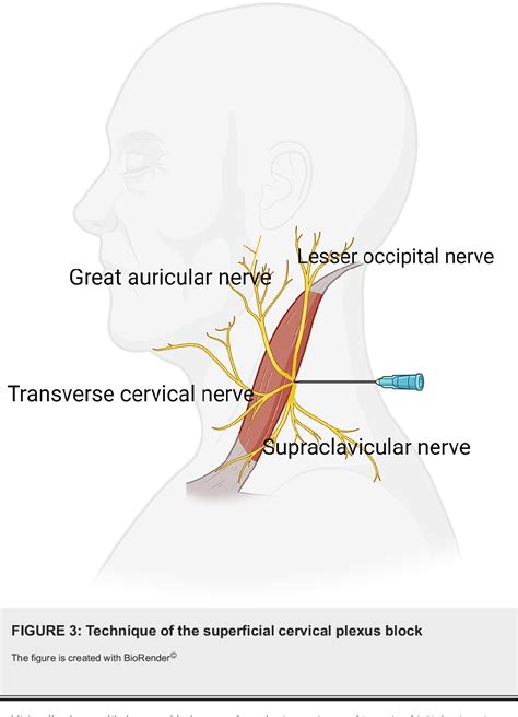 Figure 3 From Superficial Cervical Plexus Block In Selective Cases Of