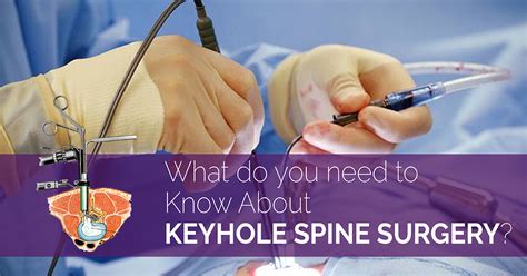 What Do You Need To Know About Keyhole Spine Surgery