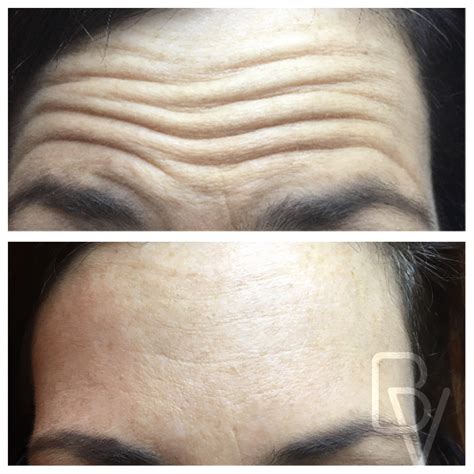 Before And After Photos Of Bella Visage Clients Lakeland