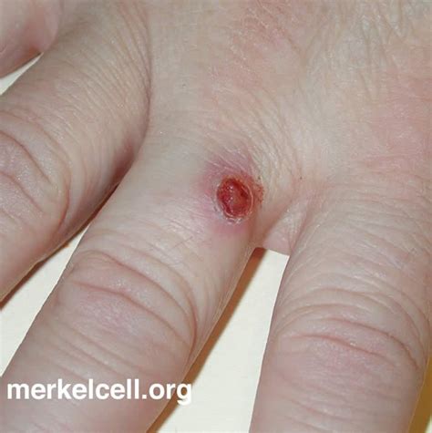 Clinical Photos Of Merkel Cell Carcinoma Merkel Cell Carcinoma